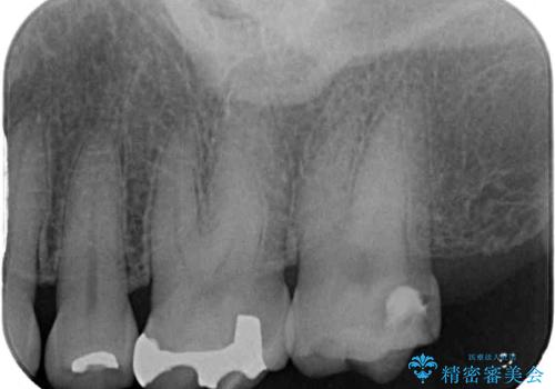 何度も外れてしまう銀歯　ゴールドインレーによる虫歯治療の治療前