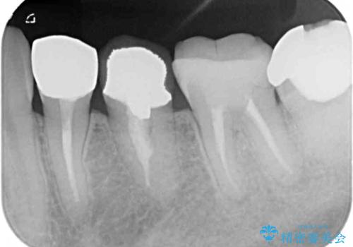 見た目の不揃いなセラミックを統一感のある歯にの治療前