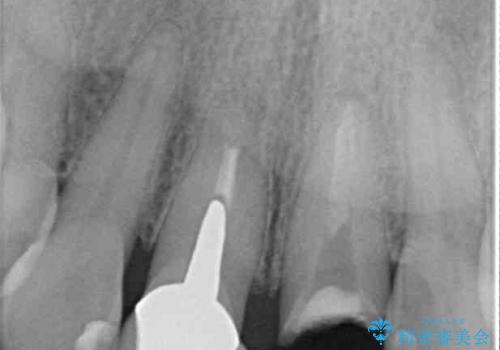 見栄えの悪い仮歯 前歯のオールセラミック治療の治療前