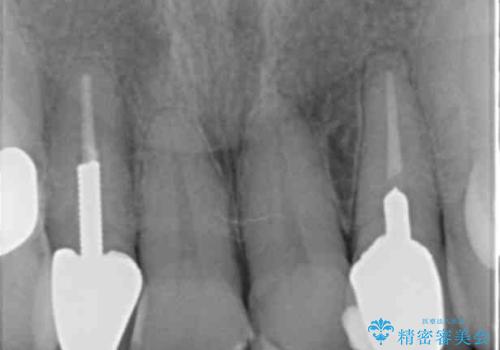 50代女性 前歯のつめものがとれた これを機に前歯をきれいにしたいの治療前