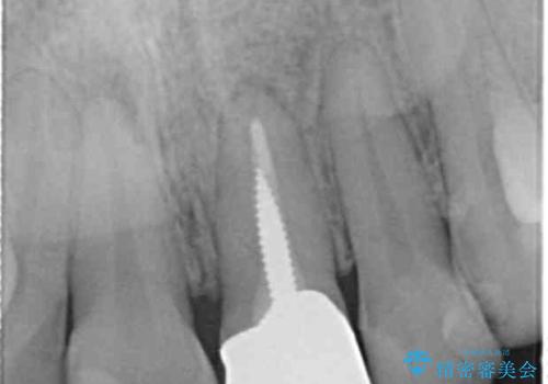 前歯の見た目を改善 セラミック審美治療の治療前