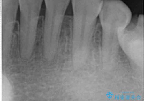 他院で矯正後、歯の神経が死んでしまった歯の治療 の治療前