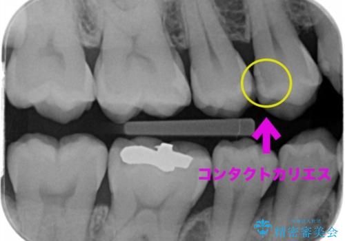 歯と歯の間の虫歯(コンタクトカリエス)の治療前