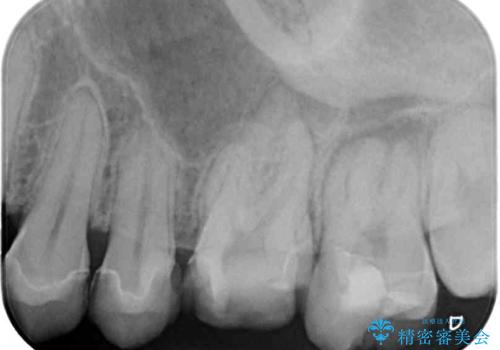 抜歯と言われた奥歯 根管治療と補綴治療の治療前