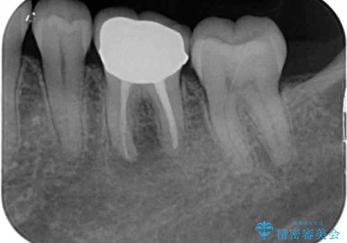 指摘された虫歯 オールセラミッククラウンによる補綴治療の治療前