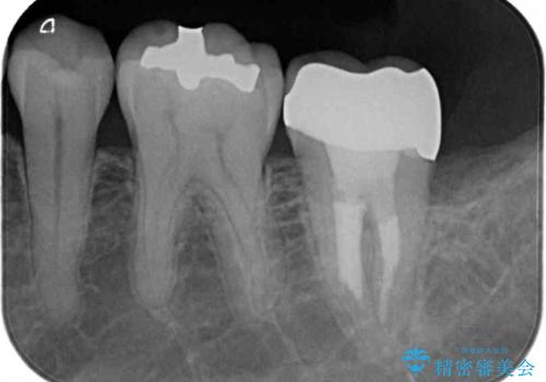 治療途中で転院 奥歯のセラミック補綴治療の治療後