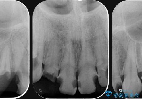 多発した前歯の重度虫歯治療の治療前