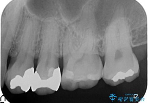 銀が目立つので白くしたいの治療前