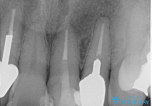 50代女性 前歯のつめものがとれた これを機に前歯をきれいにしたいの治療中