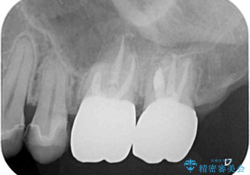 抜歯と言われた奥歯　根管治療と補綴治療の治療後