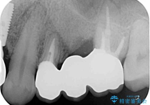 ものが挟まって痛む 割れてしまった歯のオールセラミックブリッジ治療の治療後