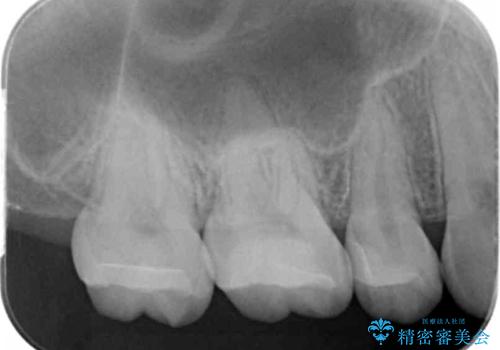 銀歯を白くしたいの治療後