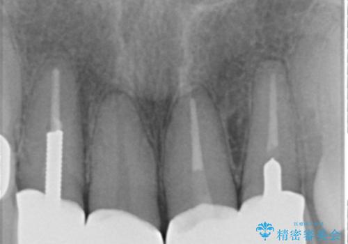 50代女性 前歯のつめものがとれた これを機に前歯をきれいにしたいの治療後