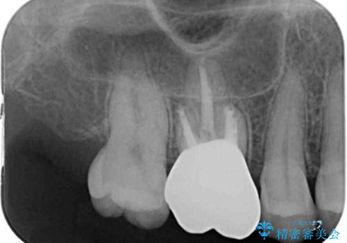指摘された虫歯 オールセラミッククラウンによる補綴治療の治療後
