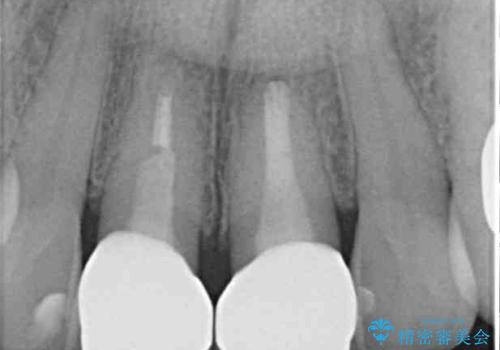 見栄えの悪い仮歯 前歯のオールセラミック治療の治療後