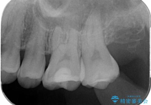 奥歯の治療の劣化が気になる。ザラザラしているの治療前