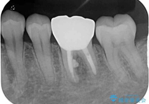 指摘された虫歯 オールセラミッククラウンによる補綴治療の治療後