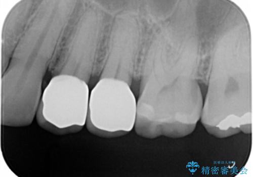 銀が目立つので白くしたいの治療後