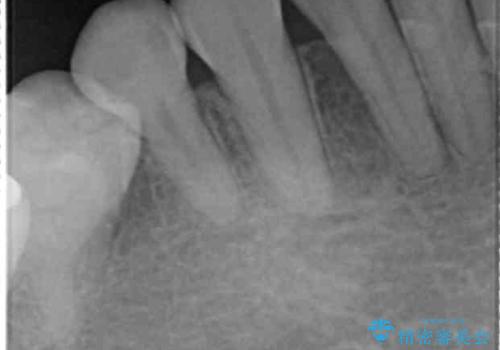 他院で矯正後、歯の神経が死んでしまった歯の治療 の治療前