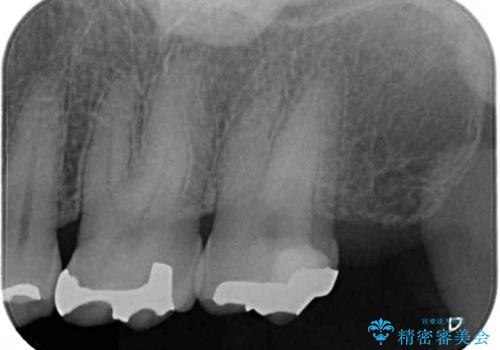何度も外れてしまう銀歯 ゴールドインレーによる虫歯治療の治療後