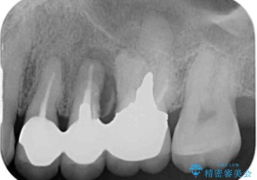 ものが挟まって痛む 割れてしまった歯のオールセラミックブリッジ治療の治療前
