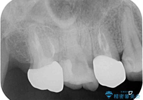 見た目の不揃いなセラミックを統一感のある歯にの治療前