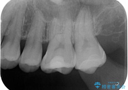 奥歯の治療の劣化が気になる。ザラザラしているの治療後