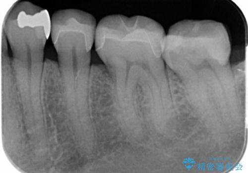 詰め物のやりかえ希望の治療後