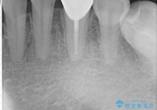 他院で矯正後、歯の神経が死んでしまった歯の治療 の治療後