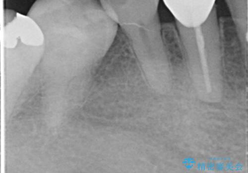 他院で矯正後、歯の神経が死んでしまった歯の治療 の治療後