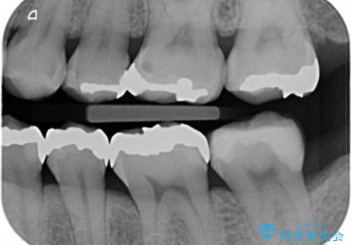 詰め物のやりかえ希望の治療前