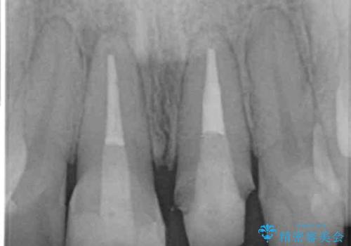 前歯の見た目を改善 セラミック審美治療の治療中