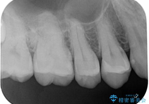 歯と歯の間の虫歯(コンタクトカリエス)の治療後
