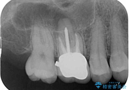 指摘された虫歯 オールセラミッククラウンによる補綴治療の治療前