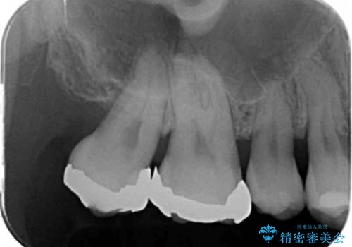 銀歯を白くしたい セラミッククラウンでの治療の治療前