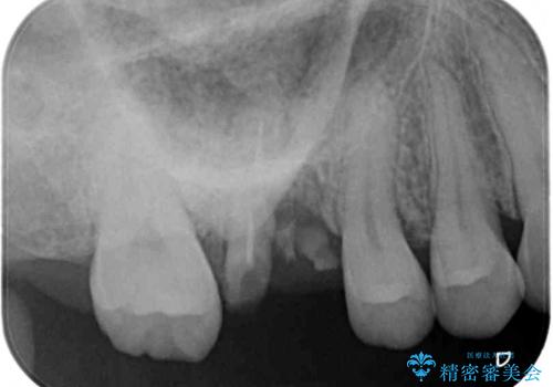 放置した奥歯の虫歯　インプラントによる欠損補綴治療の治療前