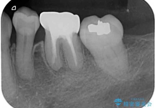 奥歯の銀歯をゴールドに　の治療前