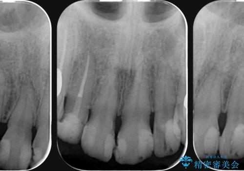 多発した前歯の重度虫歯治療の治療中