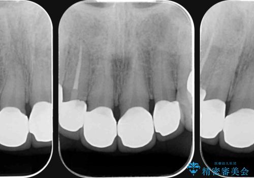 多発した前歯の重度虫歯治療の治療後