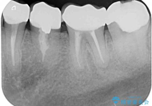 見た目の不揃いなセラミックを統一感のある歯にの治療後