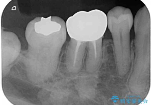 奥歯の銀歯をゴールドに　の治療後