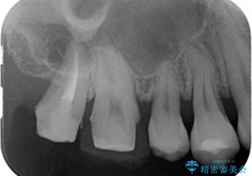 銀歯を白くしたい セラミッククラウンでの治療の治療中