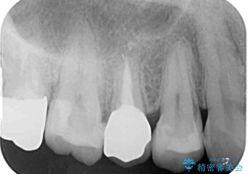 見た目の不揃いなセラミックを統一感のある歯にの治療後