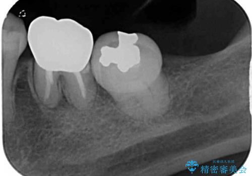 奥歯の銀歯をゴールドに　の治療後