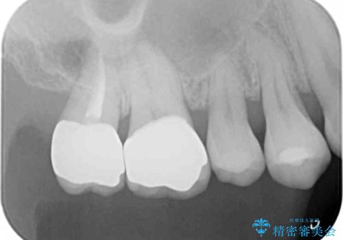 銀歯を白くしたい セラミッククラウンでの治療の治療後