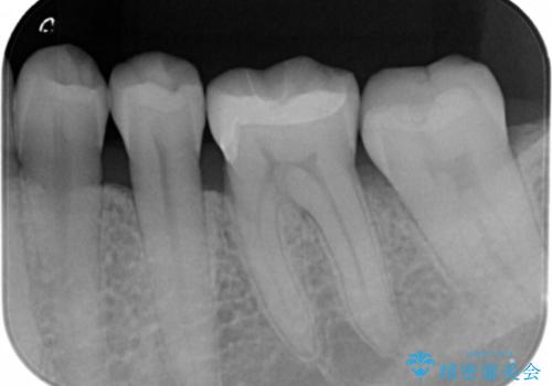 e-maxインレー治療の治療後