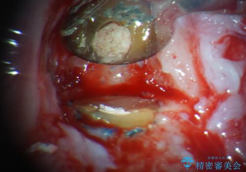見栄えの悪い仮歯 前歯のオールセラミック治療の治療中