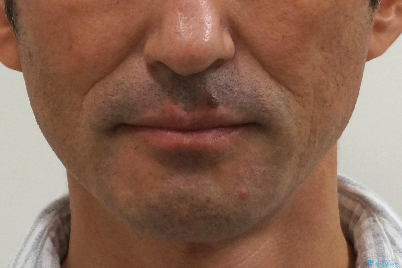 受け口 なんと部分矯正で治るんです!! インプラントを含めた総合歯科治療の治療後(顔貌)