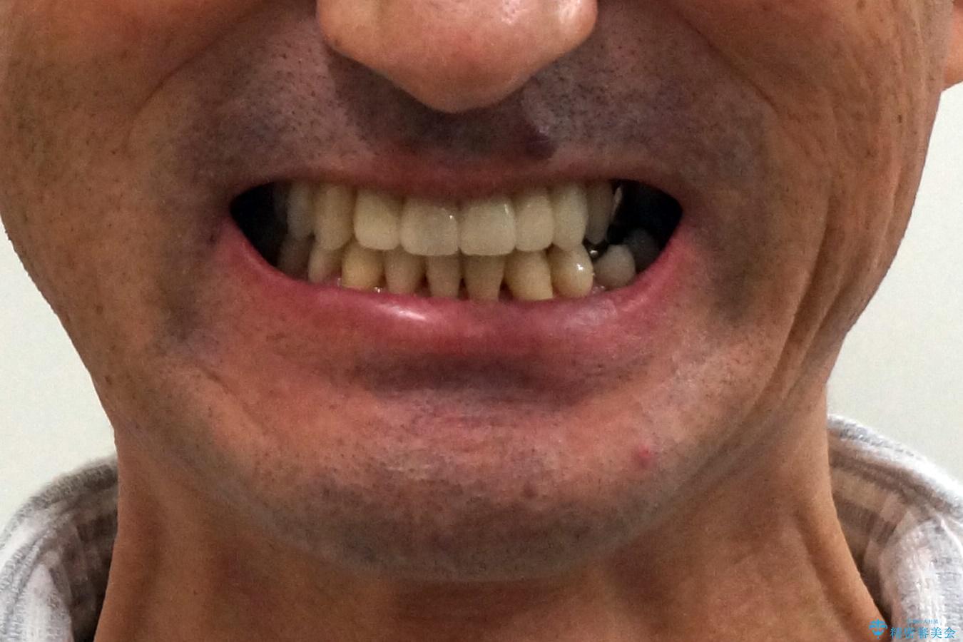 受け口 なんと部分矯正で治るんです!! インプラントを含めた総合歯科治療の治療後(顔貌)