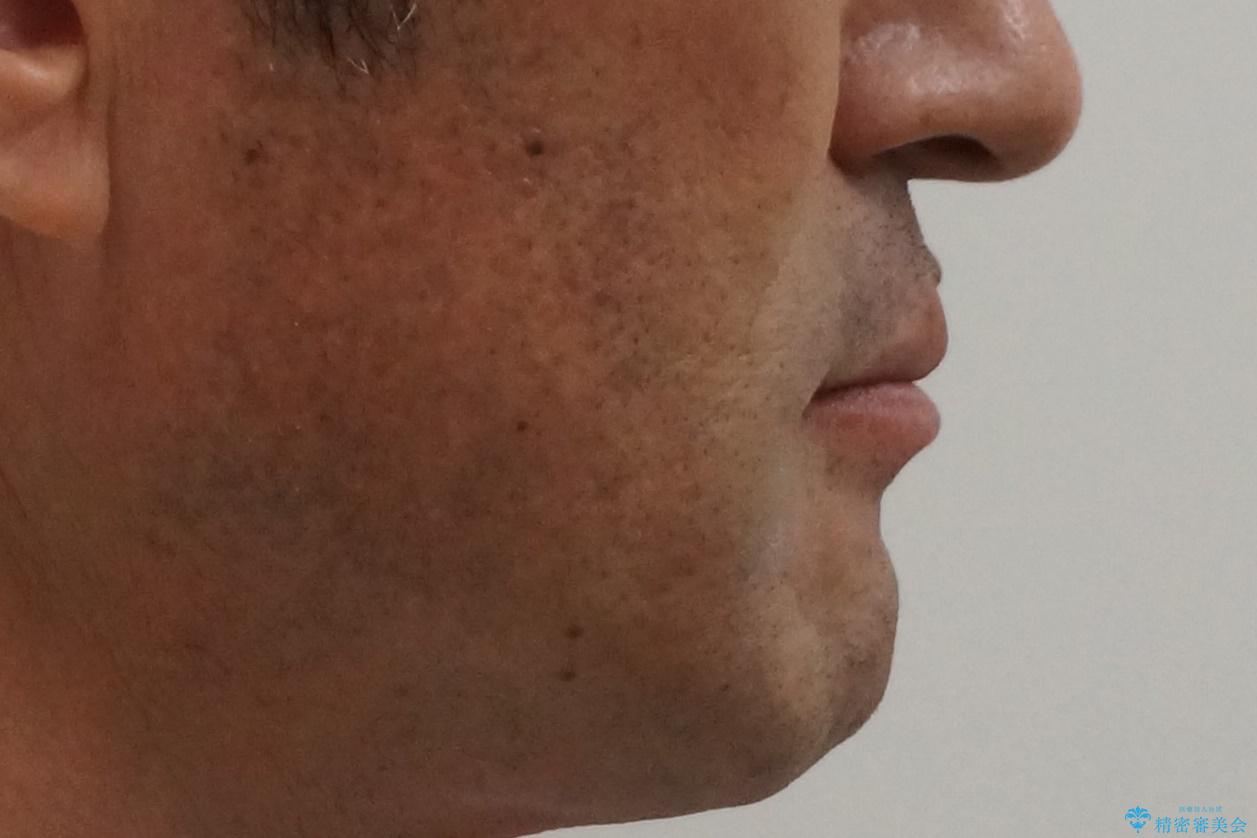 受け口 なんと部分矯正で治るんです!! インプラントを含めた総合歯科治療の治療後(顔貌)